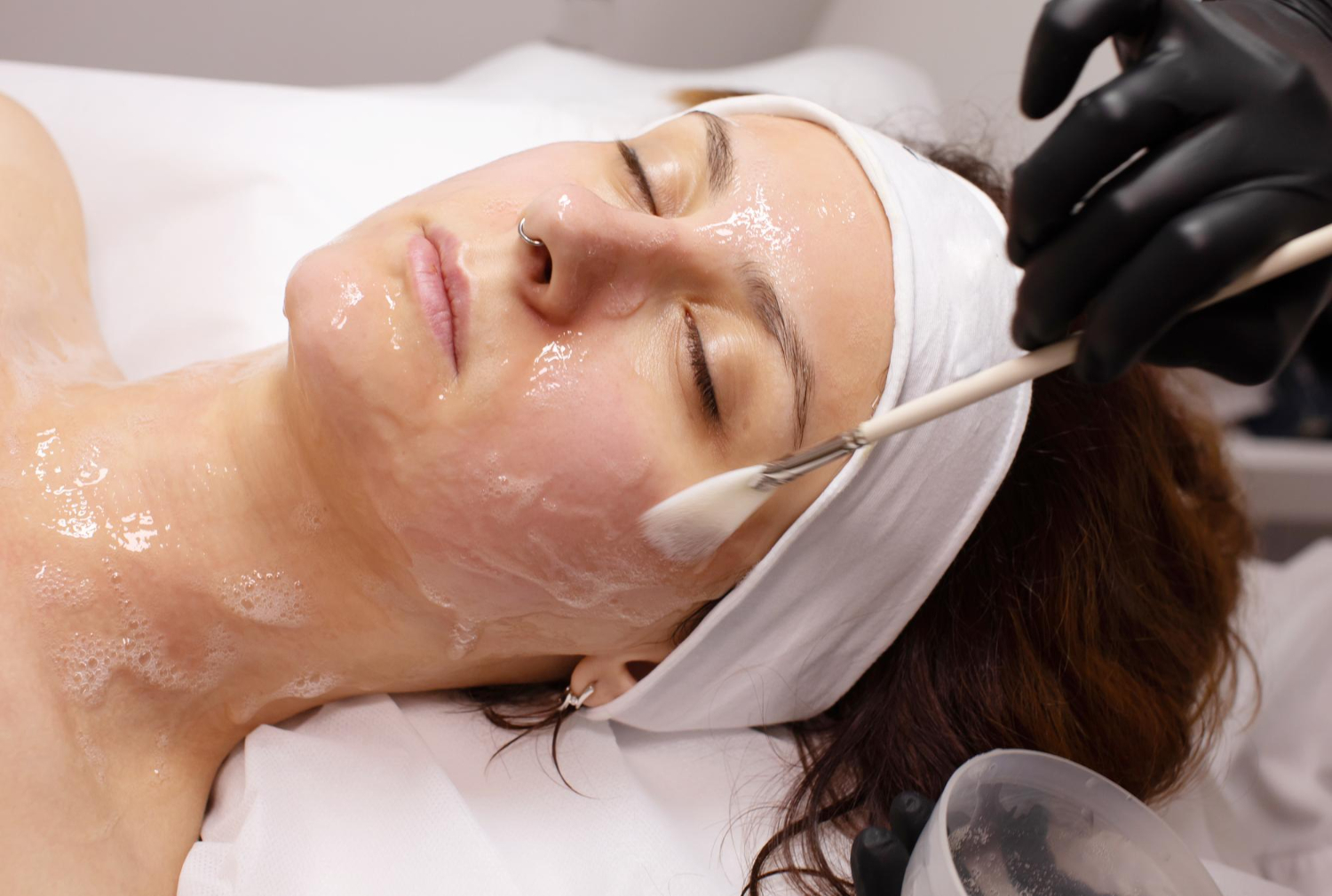 phenol peel