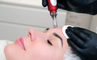 RF Microneedling Recovery Timeline in Toronto: Week-by-Week Healing Guide