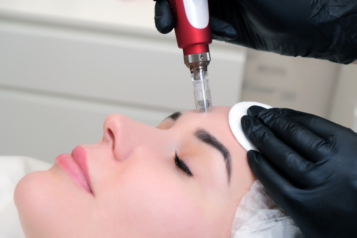 Microneedling Microneedling