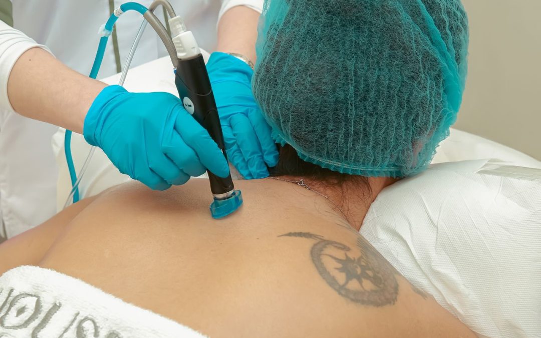 Evaluating Tattoo Removal in Toronto for Faded or Distorted Ink