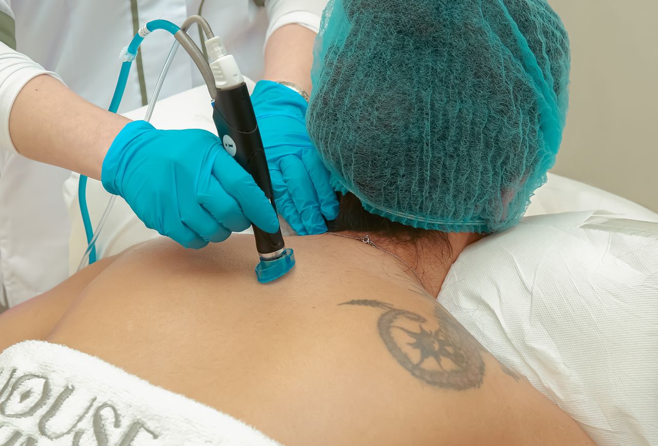 Tattoo Removal