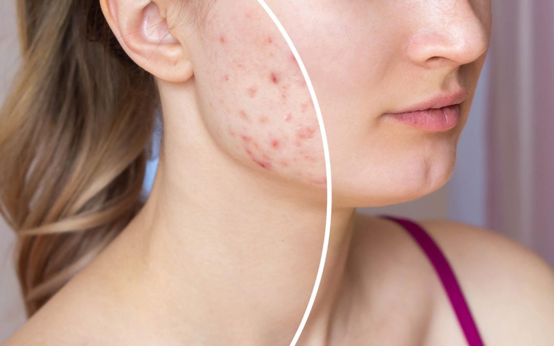 Seasonal Acne Treatment in Toronto When Weather Triggers Flares