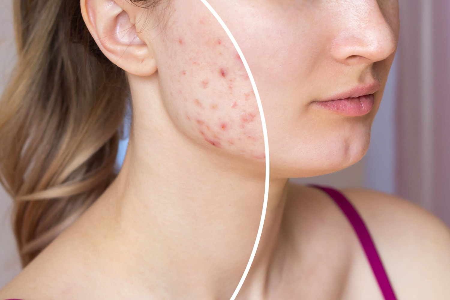 Acne Treatment