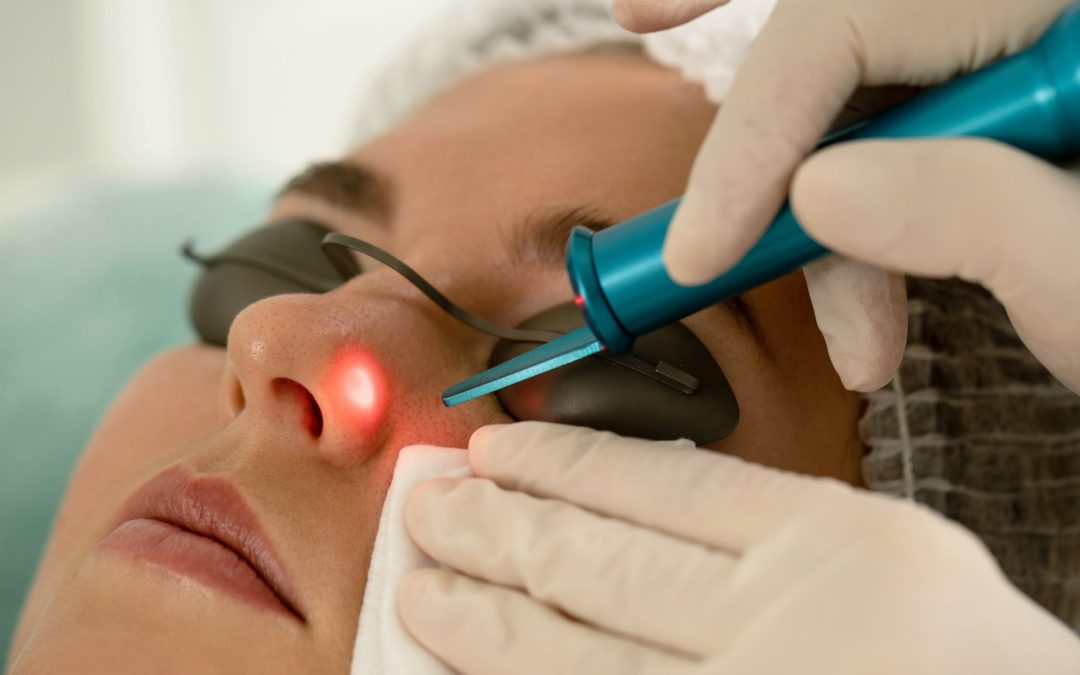 Post-Vacation Skin Rejuvenation in Toronto with Laser Facials