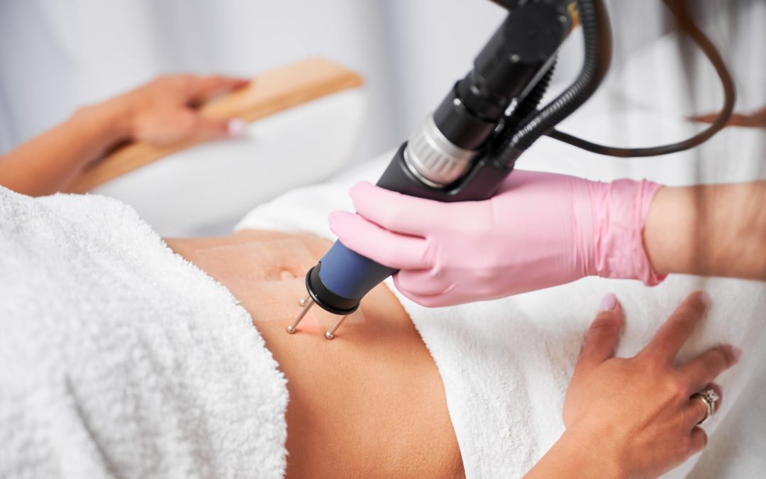 Laser Stretch Mark Removal in Toronto: Skin Tone, PIH Risk & Sun Avoidance