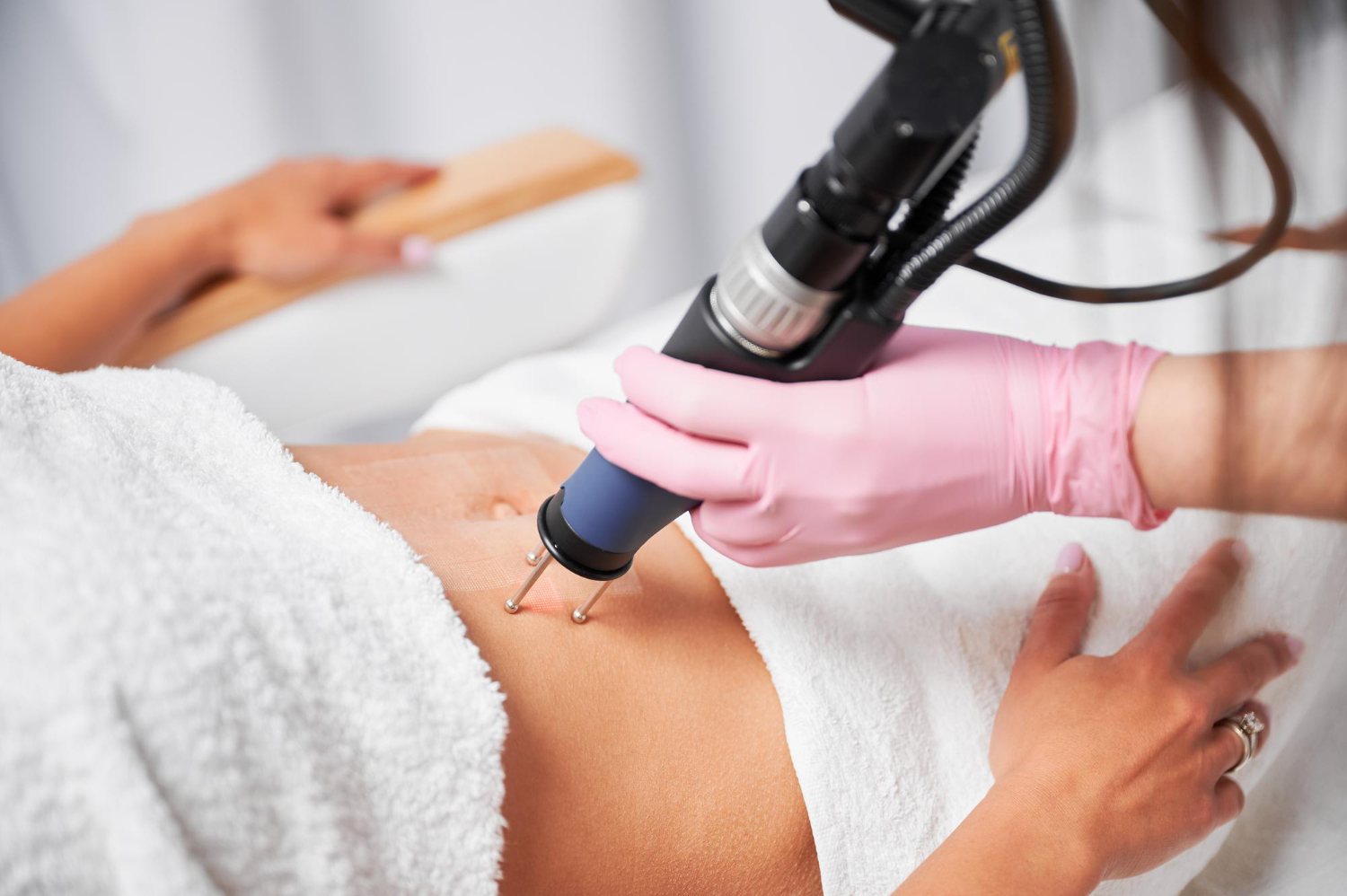 laser stretch mark removal laser stretch mark removal