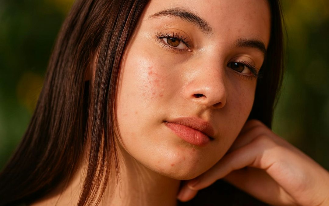 Seasonal Acne Facial Planning in Toronto for Clearer Fall Skin