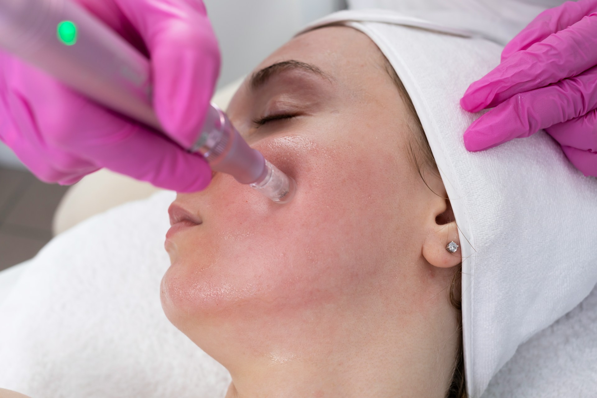 RF Microneedling RF Microneedling