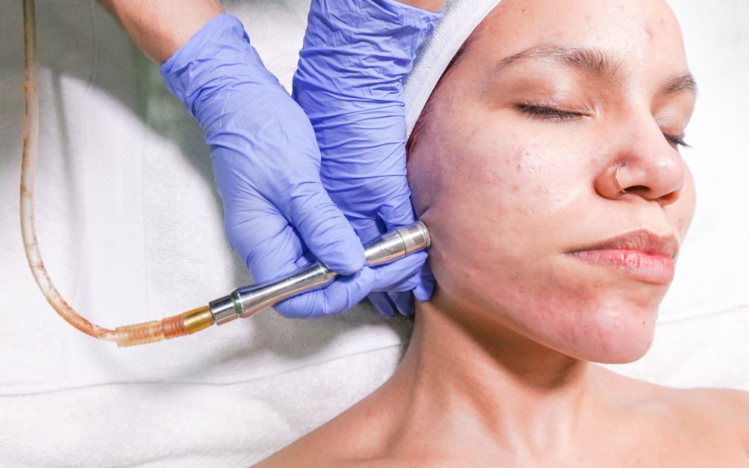 Planning Acne Scar Laser Treatment in Toronto Before Winter